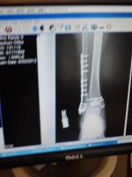 Randy's Broken Leg.jpg